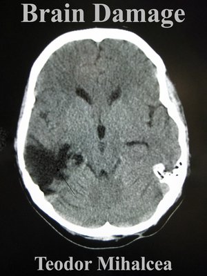 cover image of Brain Damage